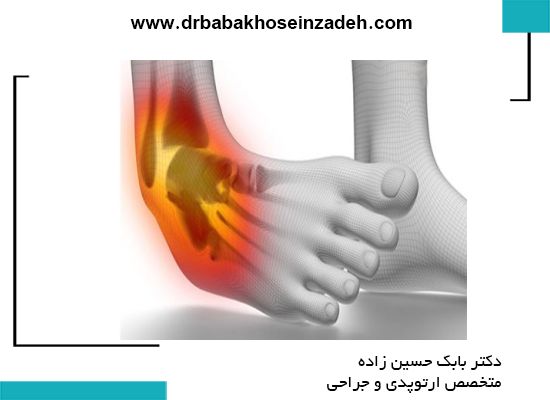 در رفتگی مفصل مچ پا