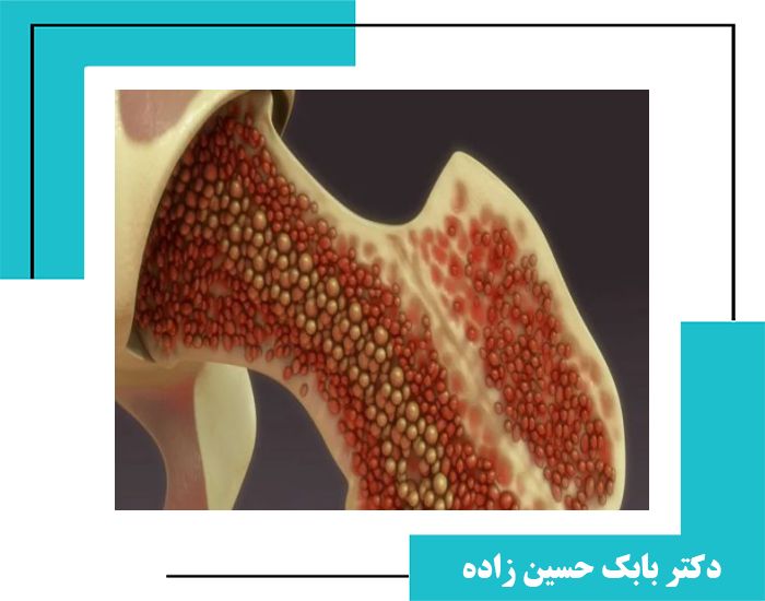 مقاله علمی -  تحلیل عملکرد تزریق پی‌آرپی و کنسانتره مغز استخوان برای درمان آرتروز زانو