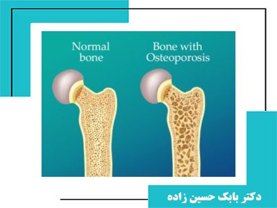 چگونه از پوکی استخوان پیشگیری کنیم : نکات و راهنمایی‌های ضروری