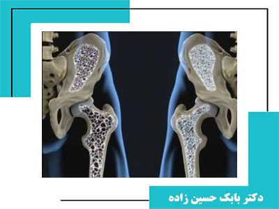 پوکی استخوان چیست ؟ آیا واقعا خطرناک است ؟