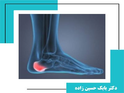 تشخیص و درمان خارپاشنه