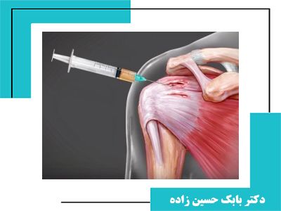جدیدترین روش‌های تزریق برای درمان قطعی شانه یخ زده | همه آنچه باید بدانید