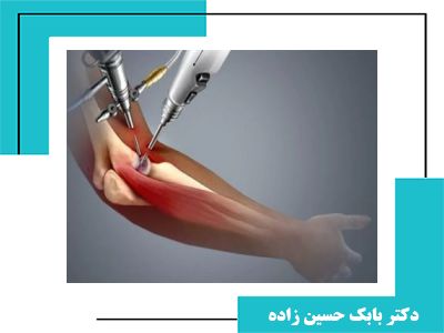 آرتروسکوپی آرنج؛ تشخیص و درمان مشکلات مفصل آرنج