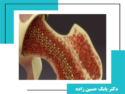 مقاله علمی -  تحلیل عملکرد تزریق پی‌آرپی و کنسانتره مغز استخوان برای درمان آرتروز زانو