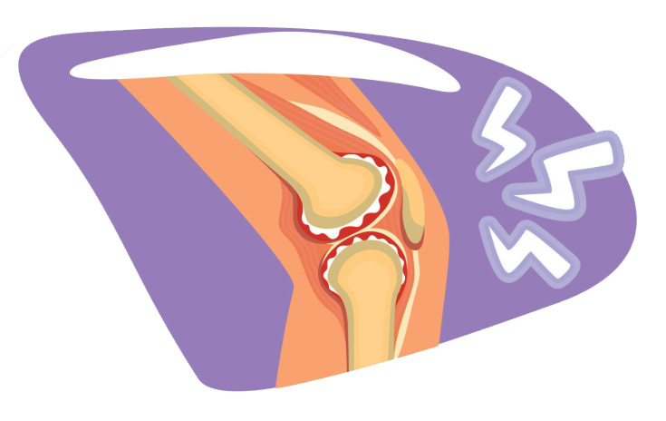 درمان آرتروز زانو بدون جراحی